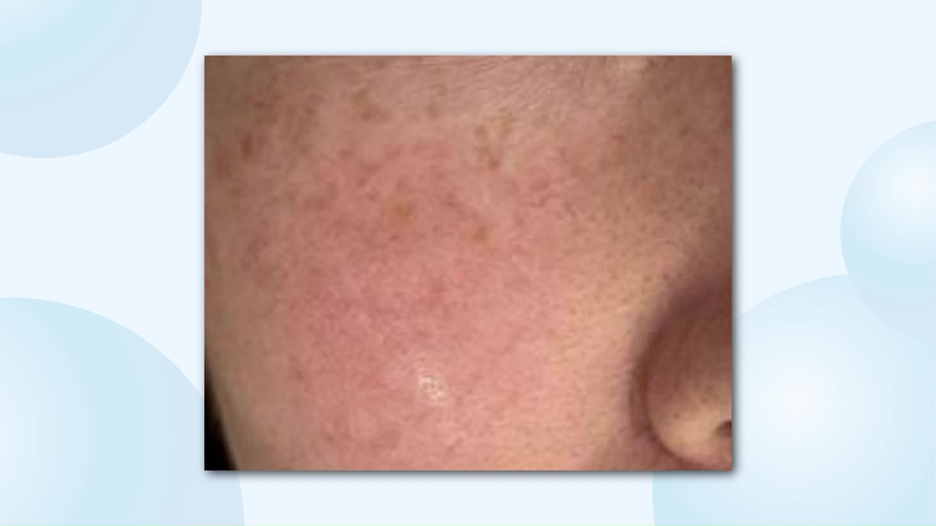 弱った肌に紫外線は大きなダメージ