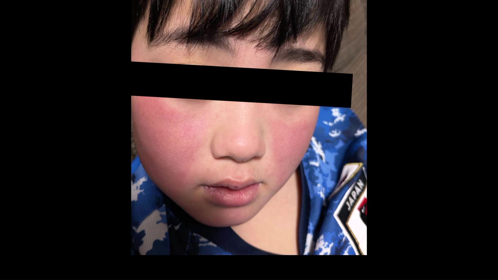 ほほが赤く染まる「リンゴ病」(提供:視聴者)