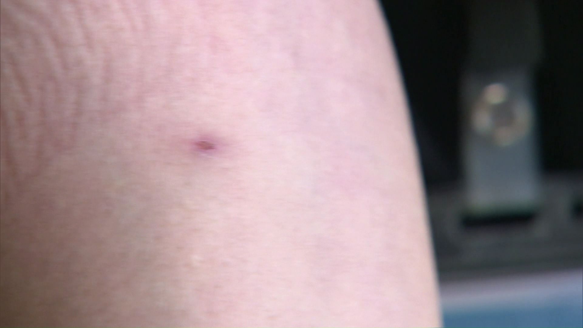 幼虫の毛に触れてかぶれた皮膚