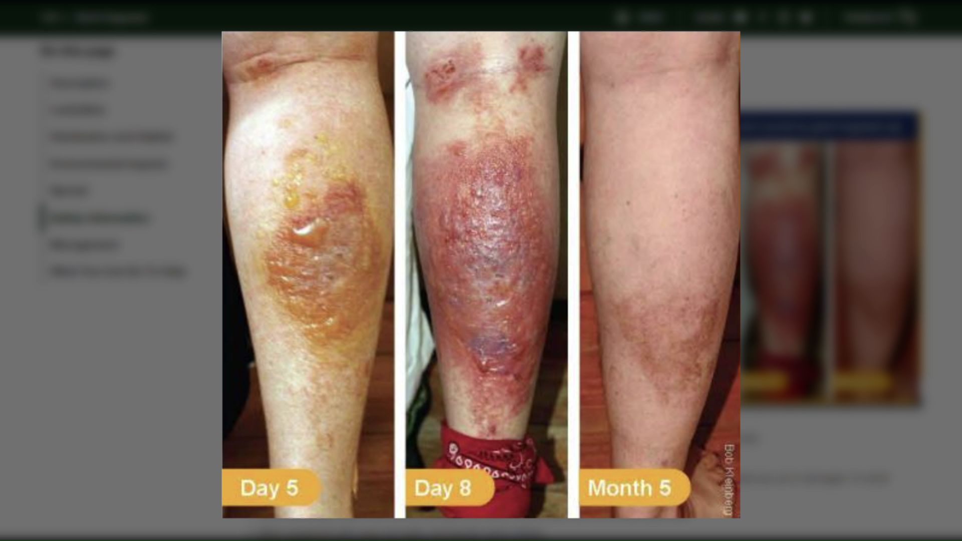 過去の皮膚炎の例(ニューヨーク州HPより)