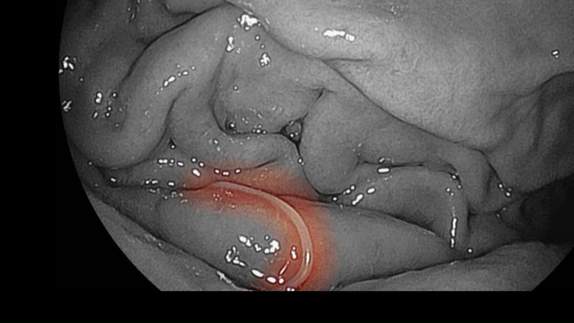 モニターに映ったのはアニサキス(実際の八木キャスターの画像)